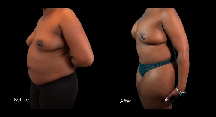 breast-reconstruction-diep-flap-case-1-2