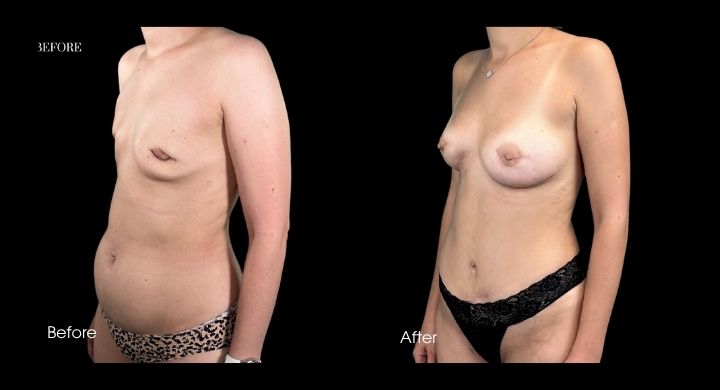 breast-reconstruction-diep-flap-case-10-1