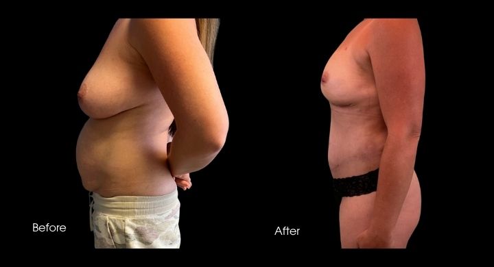 breast-reconstruction-diep-flap-case-2-1