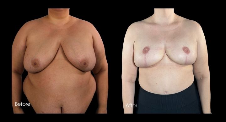 breast-reconstruction-diep-flap-case-3-1