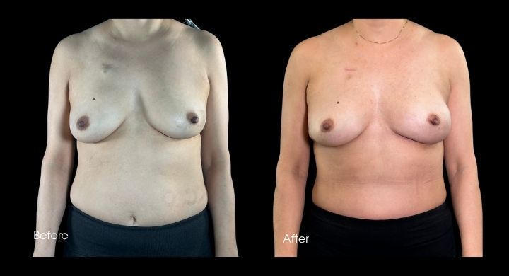 breast-reconstruction-diep-flap-case-4-1