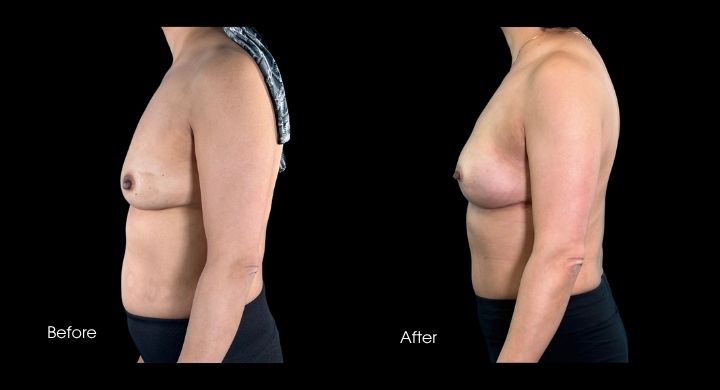 breast-reconstruction-diep-flap-case-4-2
