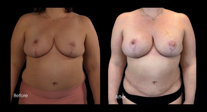 breast-reconstruction-diep-flap-case-5-1