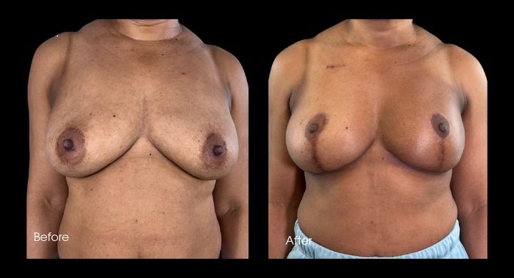 breast-reconstruction-diep-flap-case-6-1