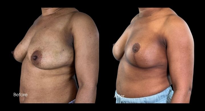 breast-reconstruction-diep-flap-case-6-2