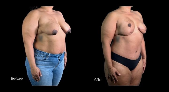 breast-reconstruction-diep-flap-case-7-1