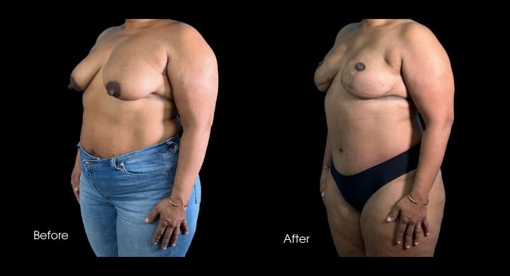 breast-reconstruction-diep-flap-case-7-2