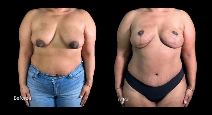 breast-reconstruction-diep-flap-case-7-3