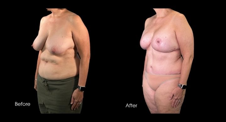 breast-reconstruction-diep-flap-case-8-1