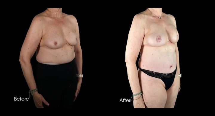 breast-reconstruction-diep-flap-case-9-1