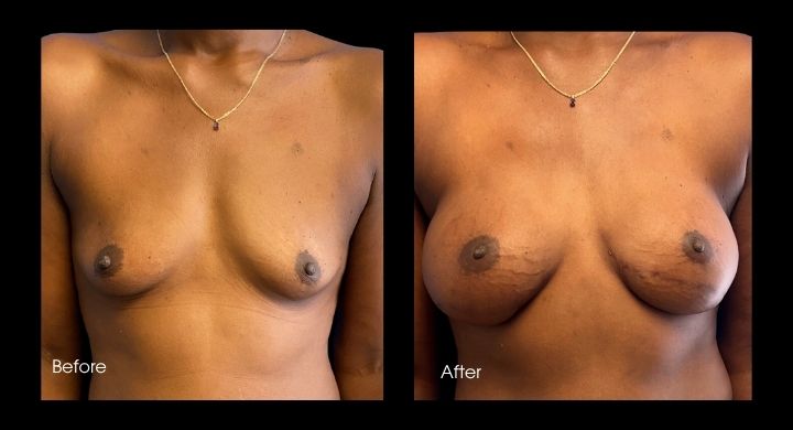 Breast Reconstruction - DIEP Flap