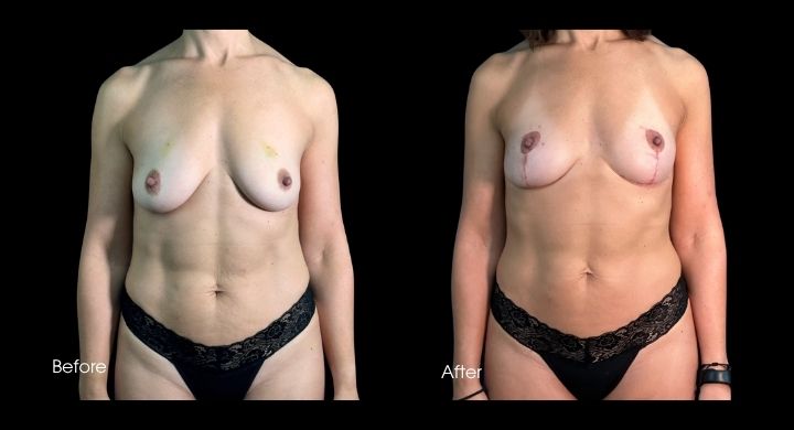 breast-reconstruction-oncoplastic-reduction-case-20-1