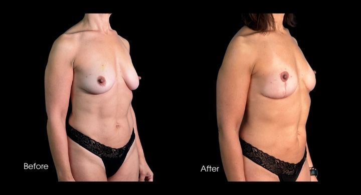 breast-reconstruction-oncoplastic-reduction-case-20-2