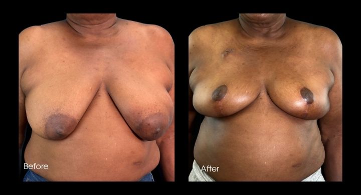 breast-reconstruction-oncoplastic-reduction-case-21-1