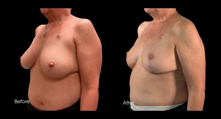 breast-reconstruction-oncoplastic-reduction-case-22-1