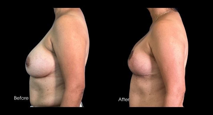 breast-reconstruction-oncoplastic-reduction-case-25-2