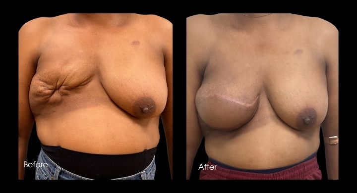 Breast Reconstruction - TDAP FLAP