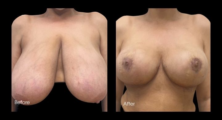 Breast Reduction (8)