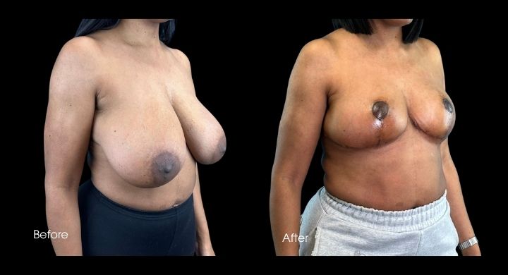 breast-reduction-case-2-1