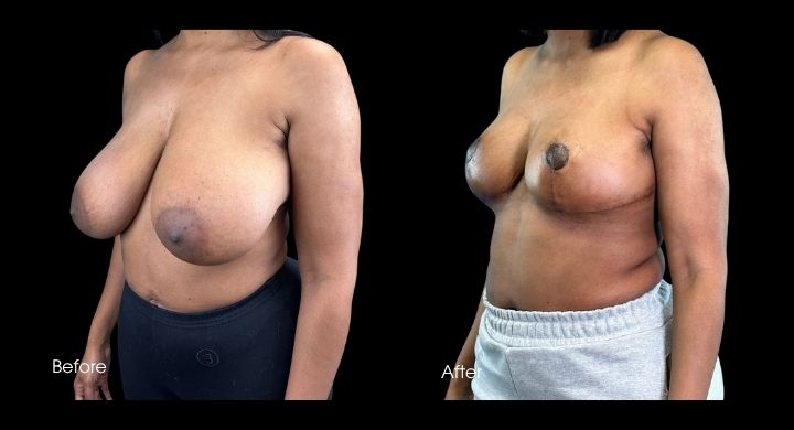 breast-reduction-case-2-2