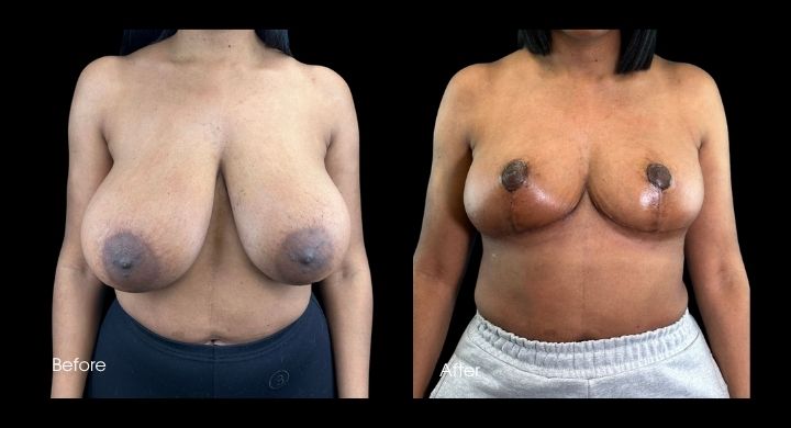 breast-reduction-case-2-3