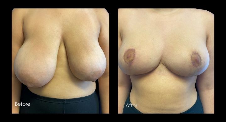 Breast Reduction