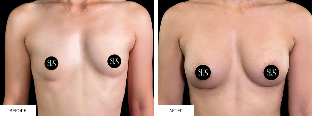 Before breast augmentation by Dr. Chris Devulapalli, frontal view