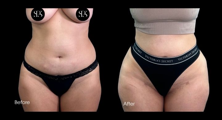 Liposuction (2)