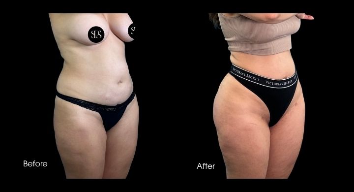 Liposuction (3)