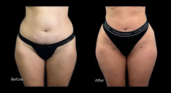 Liposuction 360