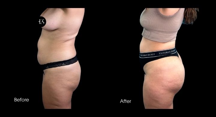 Liposuction (4)