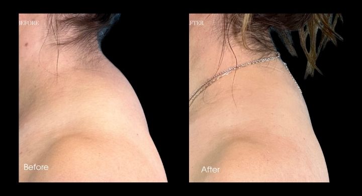 liposuction-case-1-1