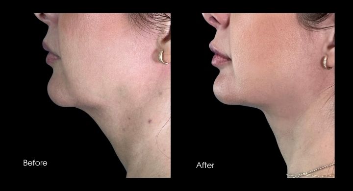 liposuction-case-1-2