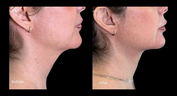 liposuction-case-1-3