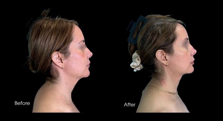 Liposuction