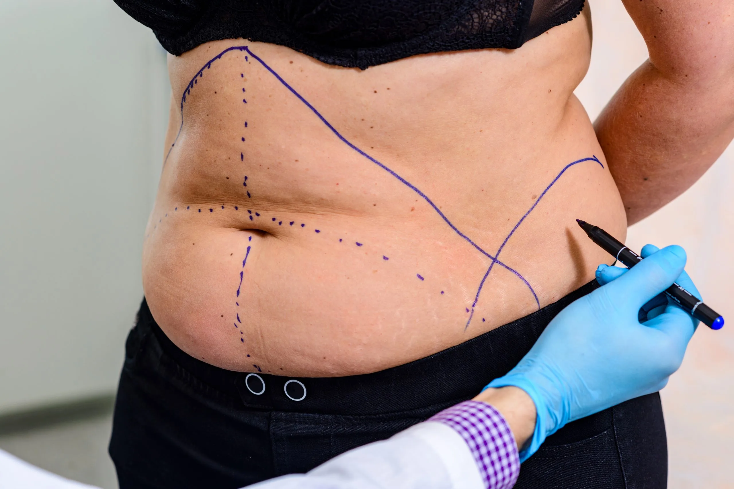 Surgeon in blue gloves marking abdomen with blue pen before body contouring procedure