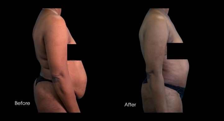 tummy-tuck-case-3-2