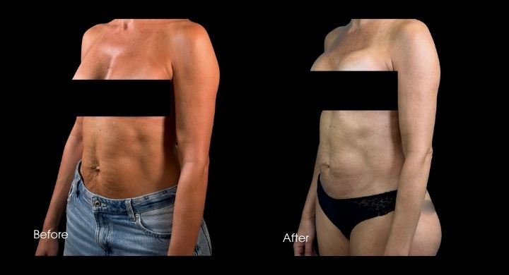 tummy-tuck-case-4-2