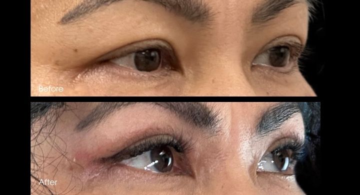 upper-blepharoplasty-case-2-2