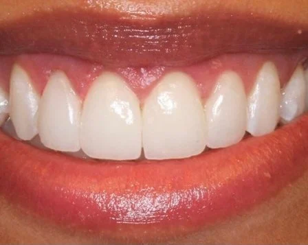 Anti Aging Dentofacial Lift 2 After - Cosmetic Dental Studios NYC