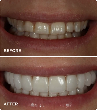 Before and after porcelain veneers transformation showing improved tooth alignment and brightness