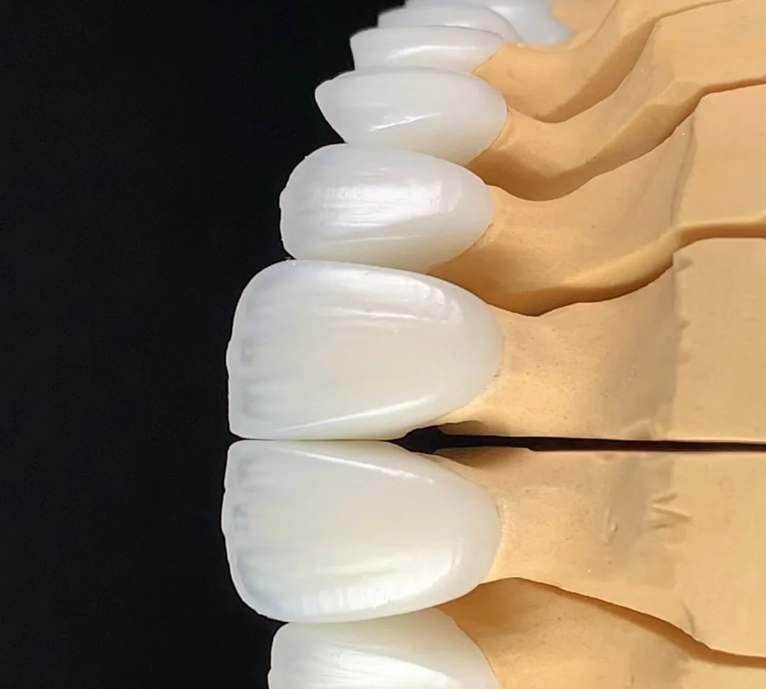 Arch of ultra-thin feldspathic porcelain veneers on a dental model