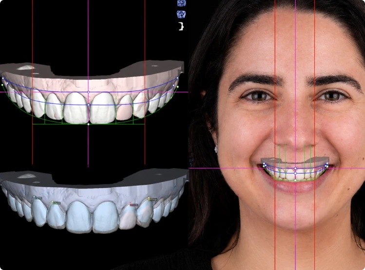 Digital smile design overlay showing porcelain veneer placement on patient's upper and lower teeth with alignment guides