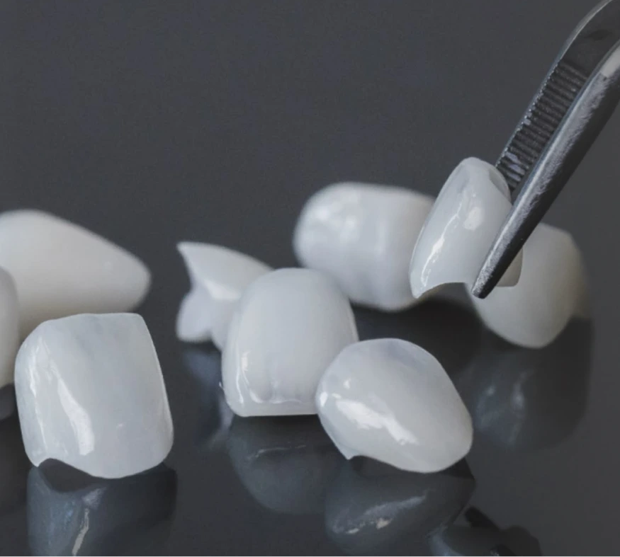 Dental technician holding porcelain veneer shade sample next to matched veneer samples on dark surface