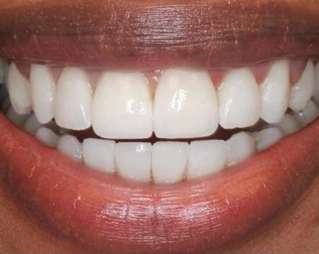 Minimal Prep Veneers 1 After - Cosmetic Dental Studios NYC