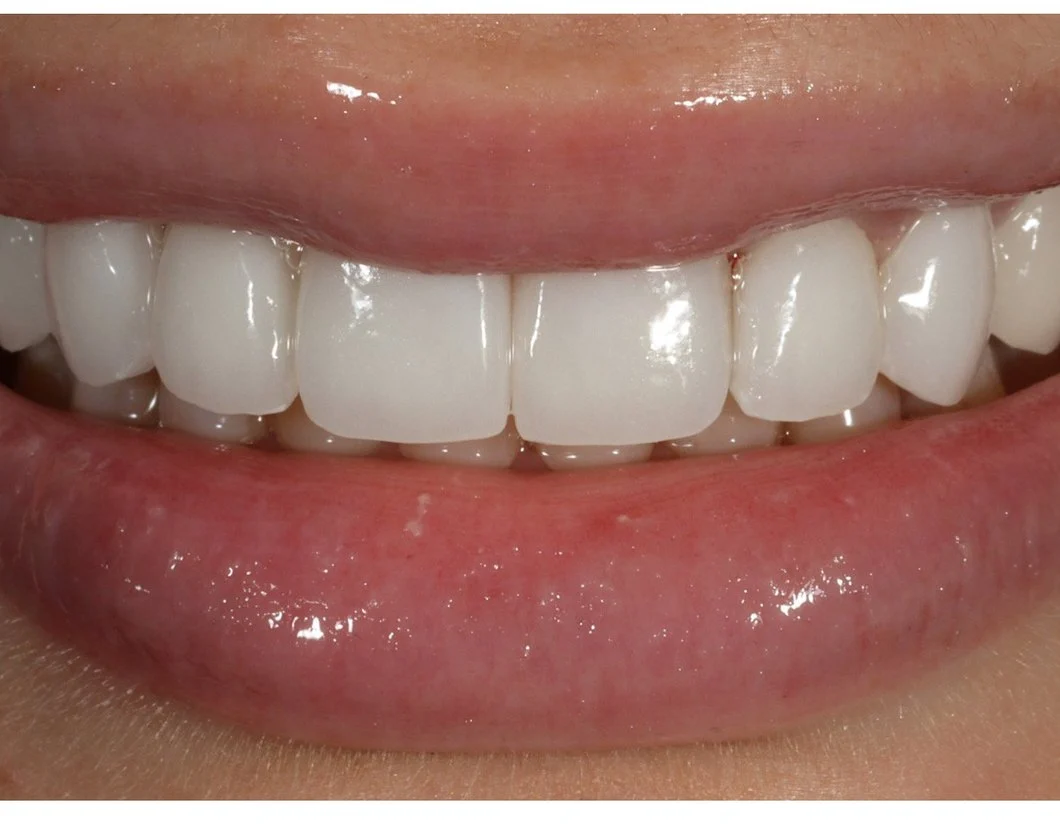 Minimal prep veneers result by Dr. Victoria Veytsman in Manhattan