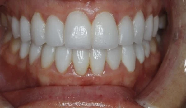 Smile Design 2 After - Cosmetic Dental Studios NYC