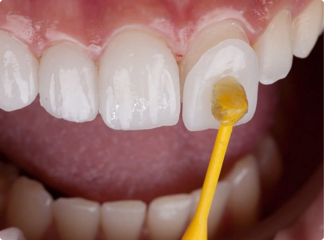 Dentist using a shade guide to match porcelain veneer color to natural teeth