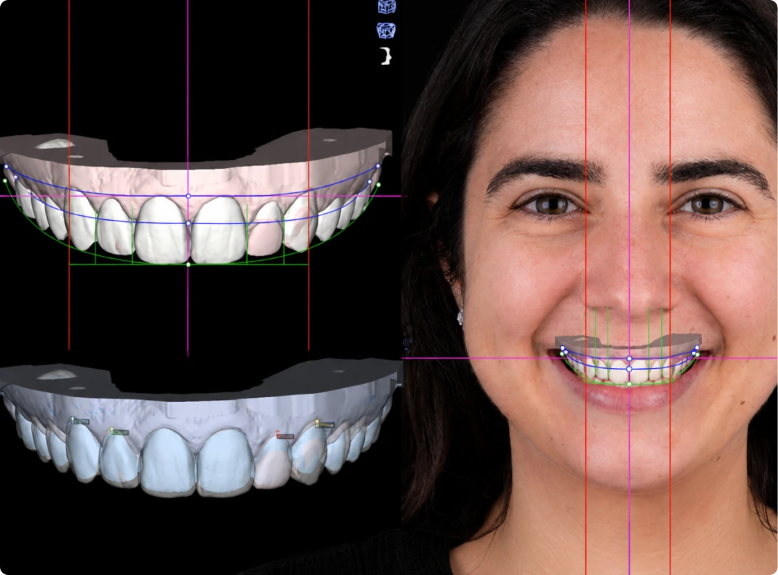 Digital smile design showing porcelain veneer placement overlaid on a patient's smile with 3D tooth models