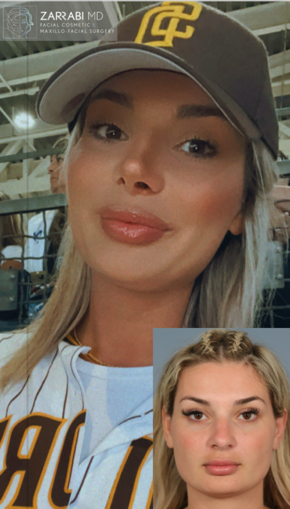 Closed Piezo Rhinoplasty